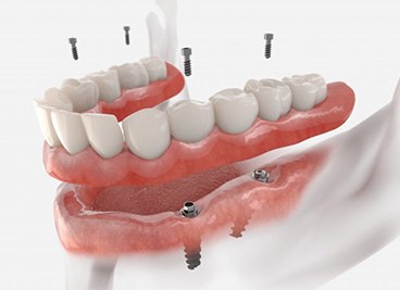 Restoring your teeth can help you pronounce words properly and speak clearly and confidently