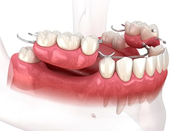 3D render of partial dentures