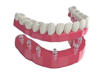 3D render of implant dentures