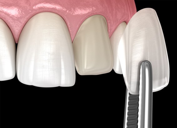 A digital image of a dental veneer 