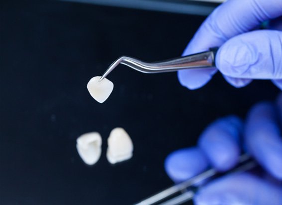 Dentist holding a veneer with a dental instrument 